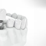 Implanty zębów – podnieś jakość i komfort życia